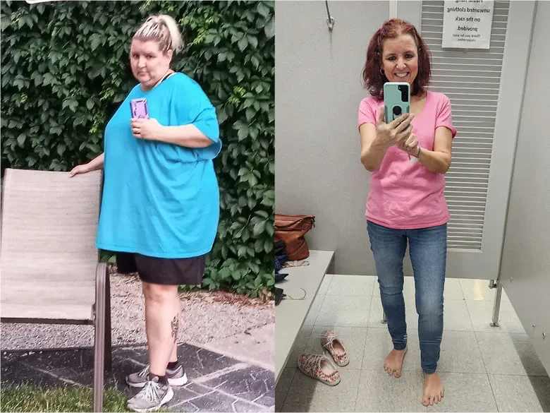 100 Gastric Sleeve Before and After pics, Weight Loss Surgery